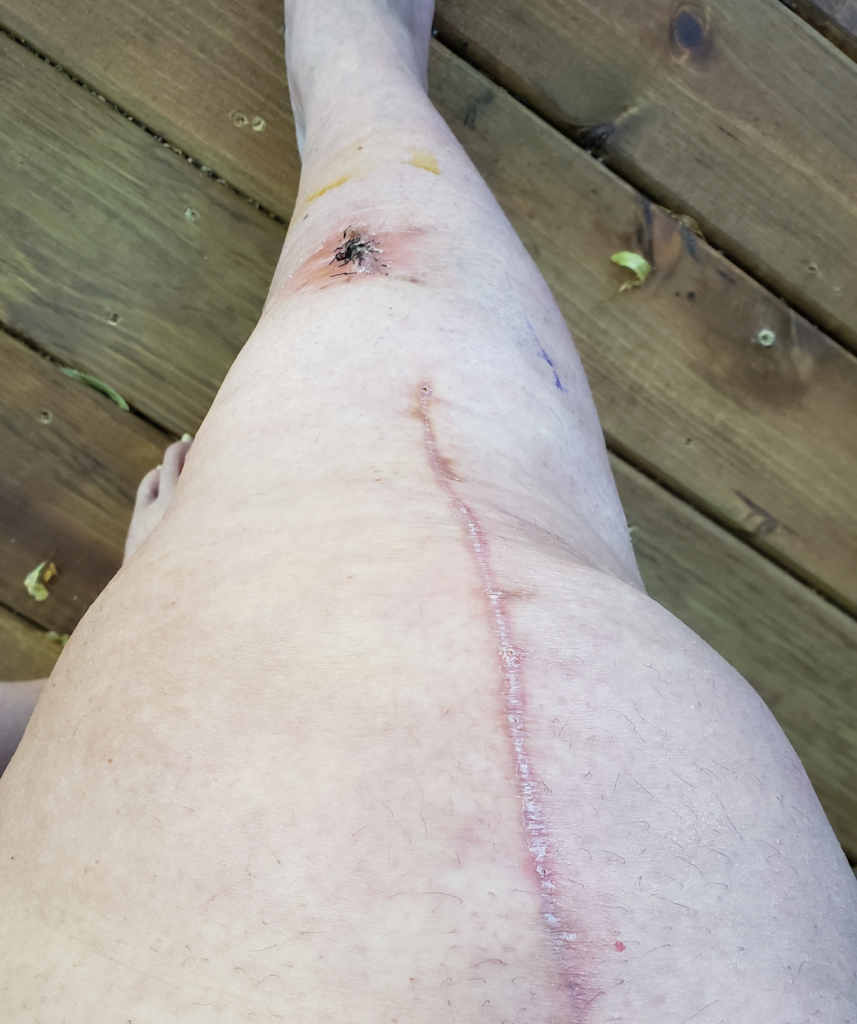 knee replacement 8 weeks post op